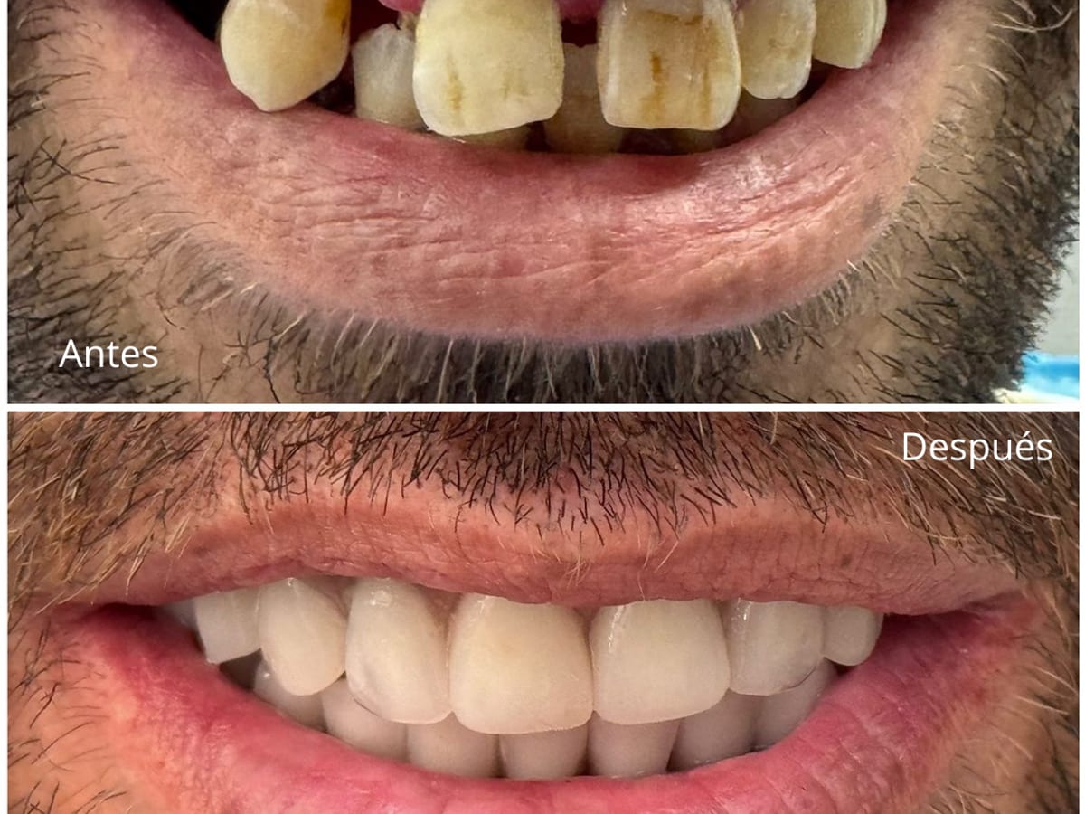 Clínica Dental Torrefiel | Implantología en Valencia — foto 3